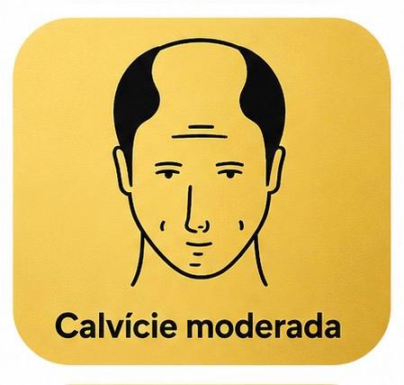 Calvície moderada
