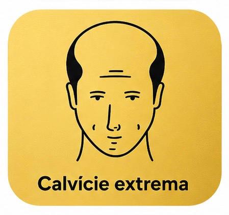 Calvície extrema